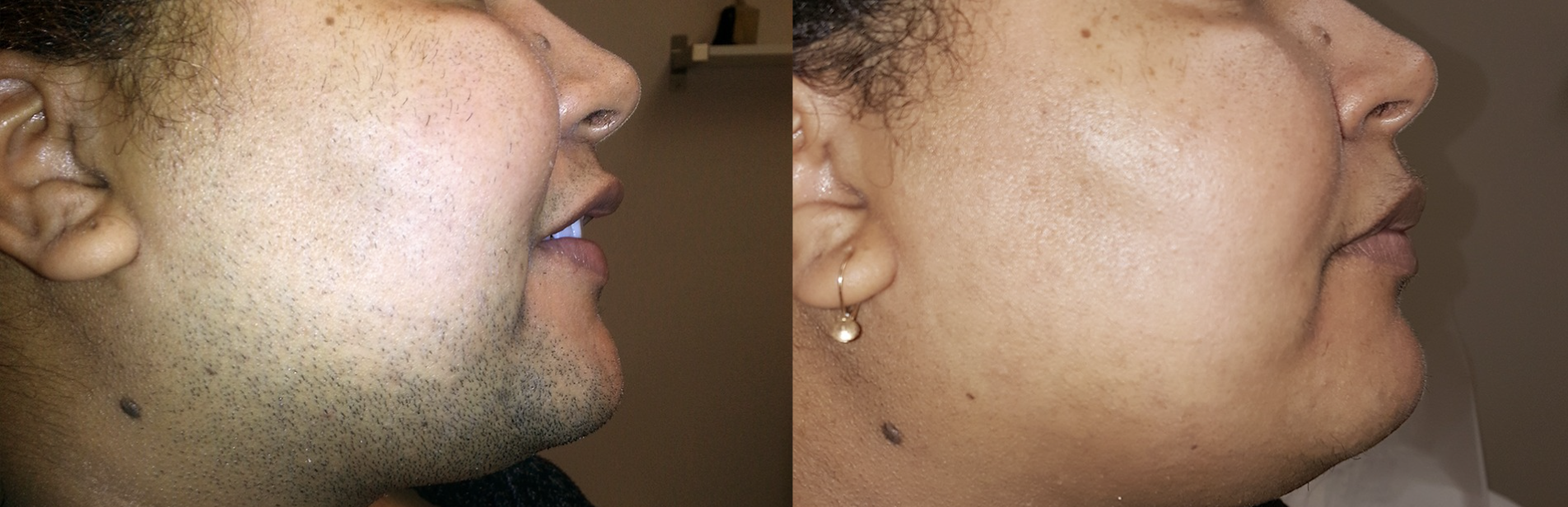 Behandlungsbeispiel Um Vorher Nachher Dermatologie Hanau